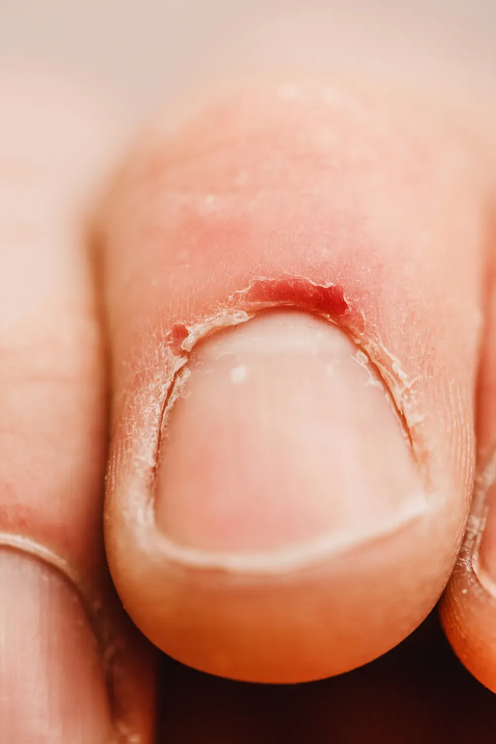 Cuticle Damage