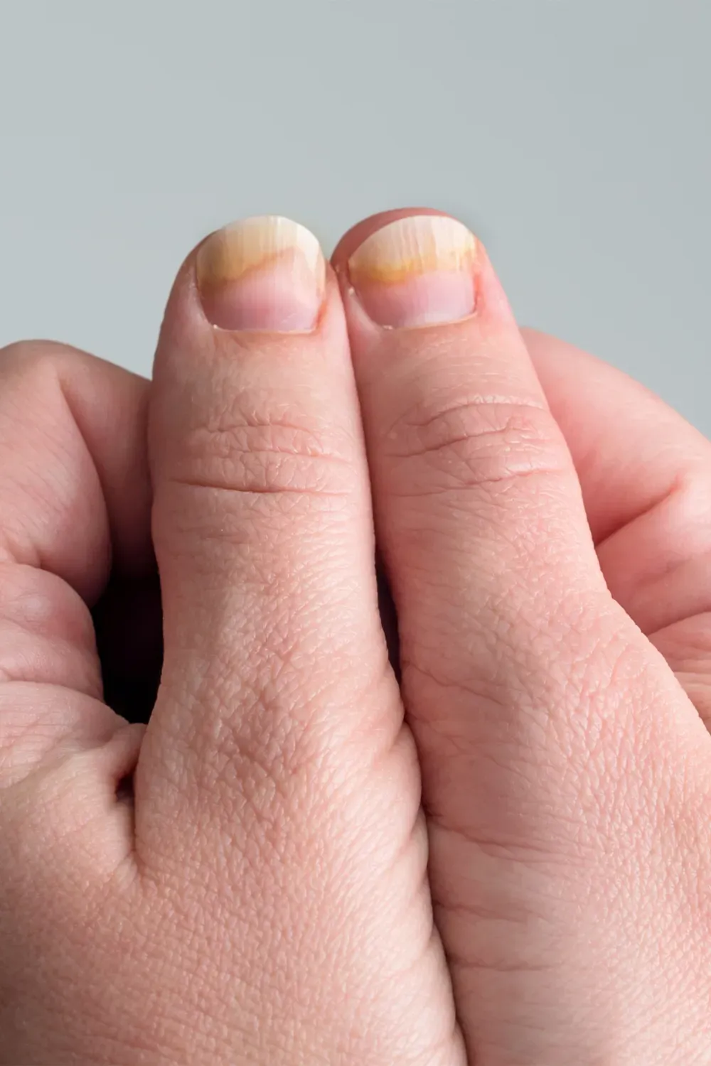 Nail Fungal Infections