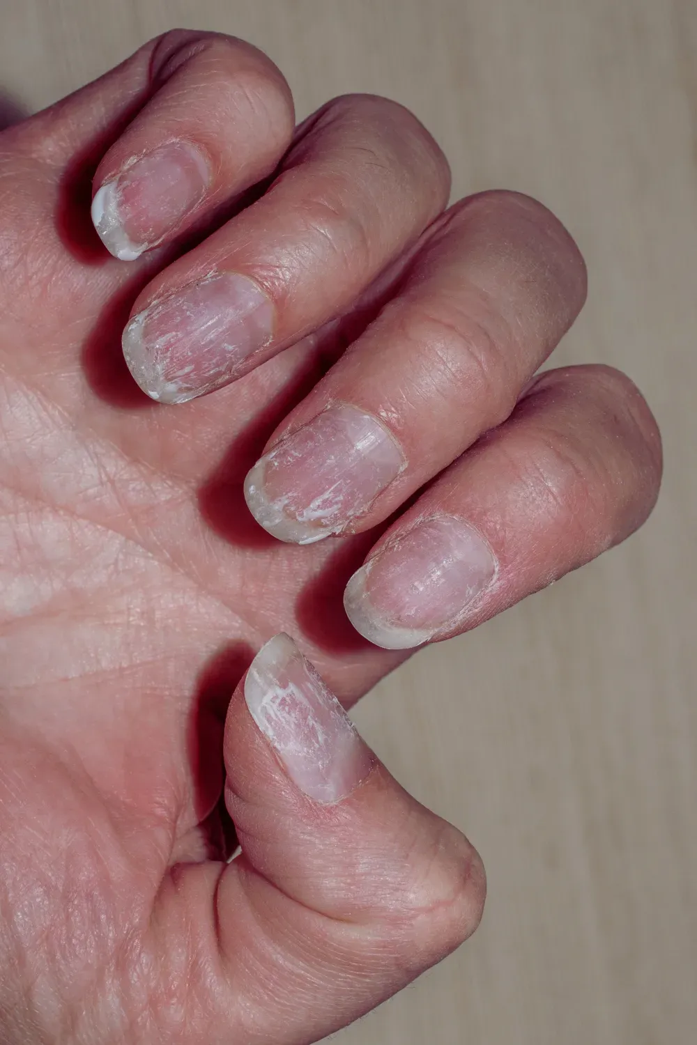 Thin and peeling nails - Weak, peeling nails from constant nail product application
