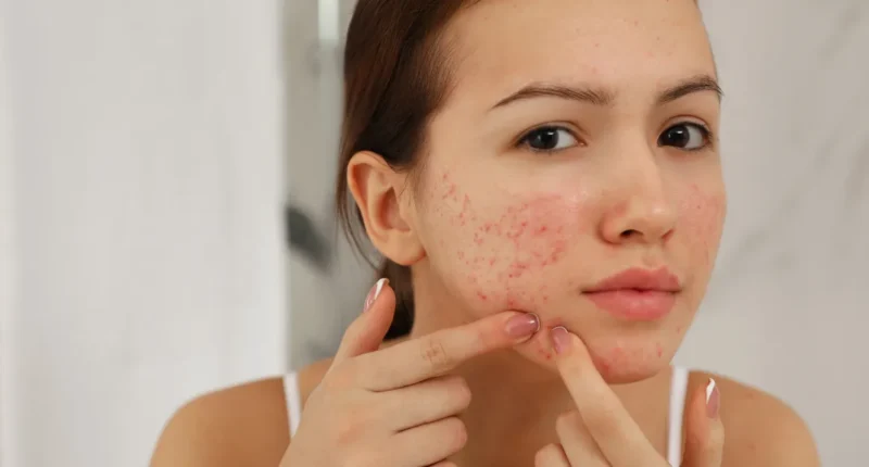 Close-up of a young woman with a clear complexion gently pressing her cheeks and chin, showing red acne spots